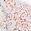 A IMUNO-HISTOQUÍMICA NO MELANOMA